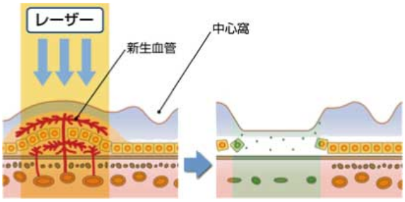 変性 加 齢 黄斑